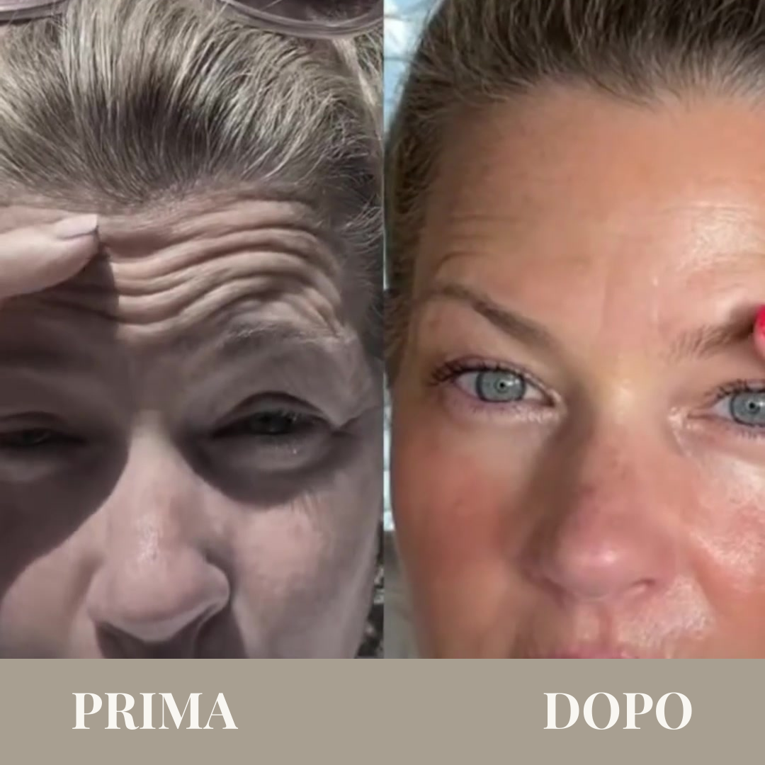 Newal™ – Trattamento di micro-infusione anti-age ad alte prestazioni