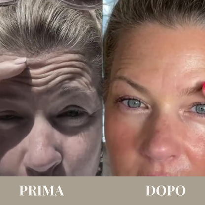 Newal™ – Trattamento di micro-infusione anti-age ad alte prestazioni